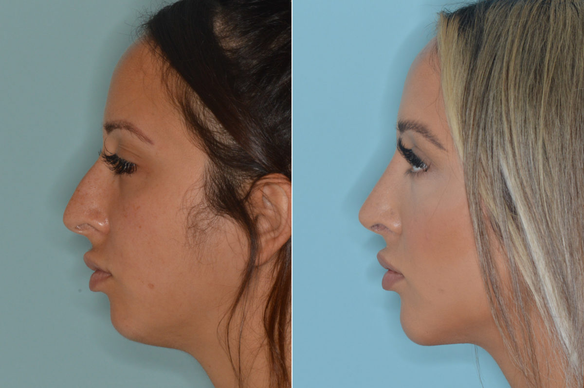 Rhinoplasty Before and After Photos in Miami, FL, Patient 4432