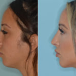 Rhinoplasty Before and After Photos in Miami, FL, Patient 4432