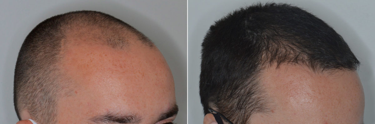 Hair Transplant Before and After Photos in Miami, FL, Patient 4442