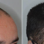 Hair Transplant Before and After Photos in Miami, FL, Patient 4442