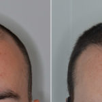 Hair Transplant Before and After Photos in Miami, FL, Patient 4442