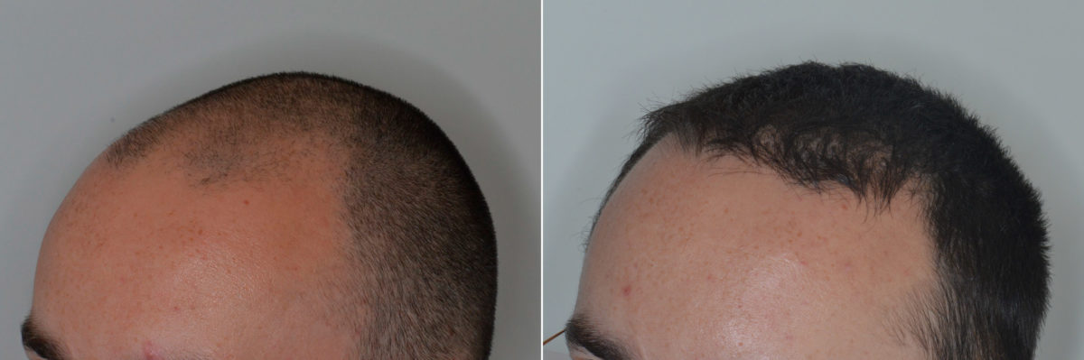 Hair Transplant Before and After Photos in Miami, FL, Patient 4442