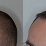 Hair Transplant Before and After Photos in Miami, FL, Patient 4442