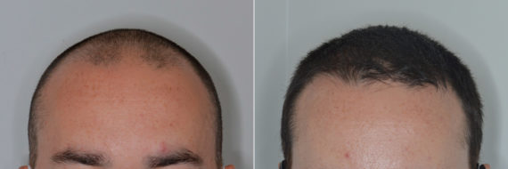 Hair Transplant Before and After Photos in Miami, FL, Patient 4442