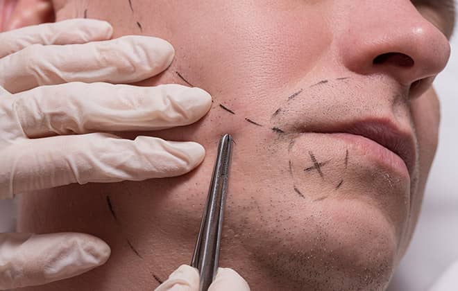 Surgical Techniques for Beard Implants