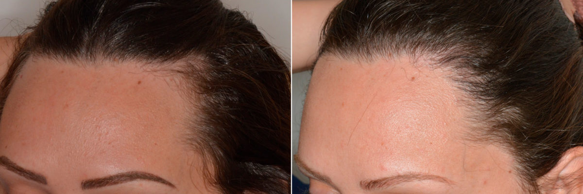 Hair Restoration Before and After Photos in Miami, FL, Patient 4486