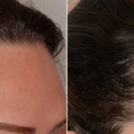 Hair Restoration Before and After Photos in Miami, FL, Patient 4486