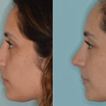 Rhinoplasty Before and After Photos in Miami, FL, Patient 4611