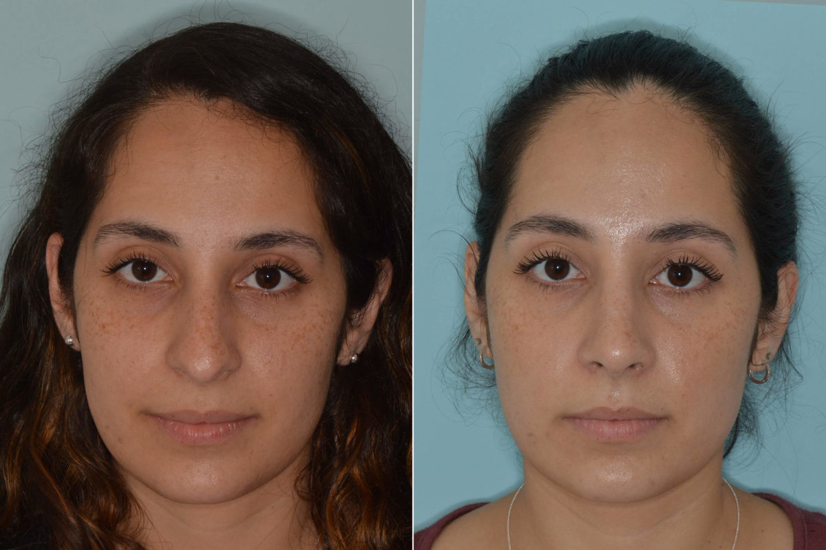 Rhinoplasty Before and After Photos in Miami, FL, Patient 4611