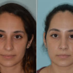 Rhinoplasty Before and After Photos in Miami, FL, Patient 4611