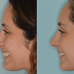 Rhinoplasty Before and After Photos in Miami, FL, Patient 4611