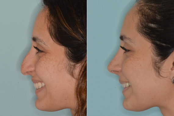 Rhinoplasty Before and After Photos in Miami, FL, Patient 4611