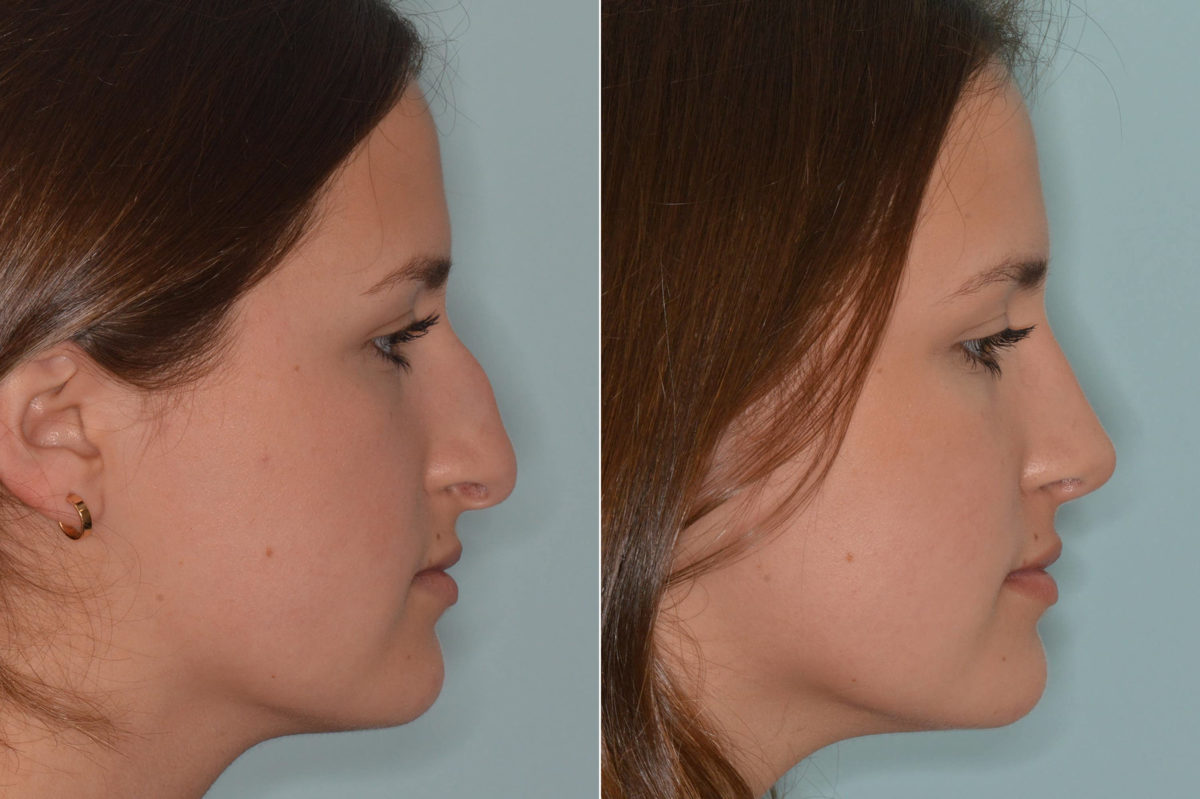 Rhinoplasty Before and After Photos in Miami, FL, Patient 4633