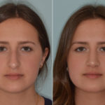 Rhinoplasty Before and After Photos in Miami, FL, Patient 4633