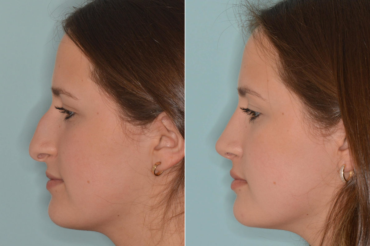 Rhinoplasty Before and After Photos in Miami, FL, Patient 4633