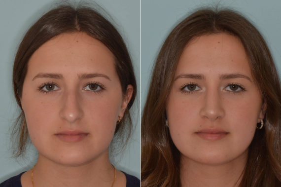 Rhinoplasty Before and After Photos in Miami, FL, Patient 4633