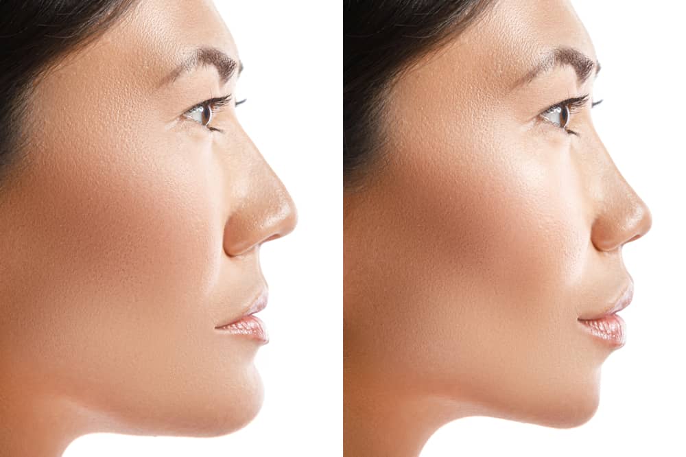 Certain ethnicities tend to share similar nasal features.