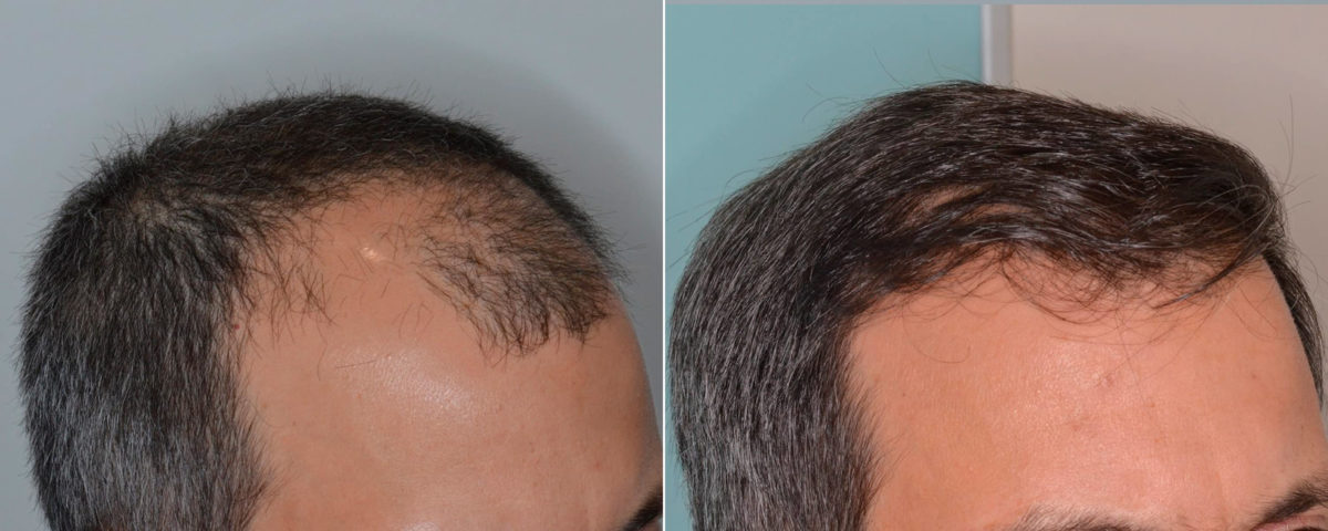 Hair Transplant Before and After Photos in Miami, FL, Patient 4818