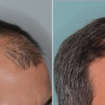 Hair Transplant Before and After Photos in Miami, FL, Patient 4818