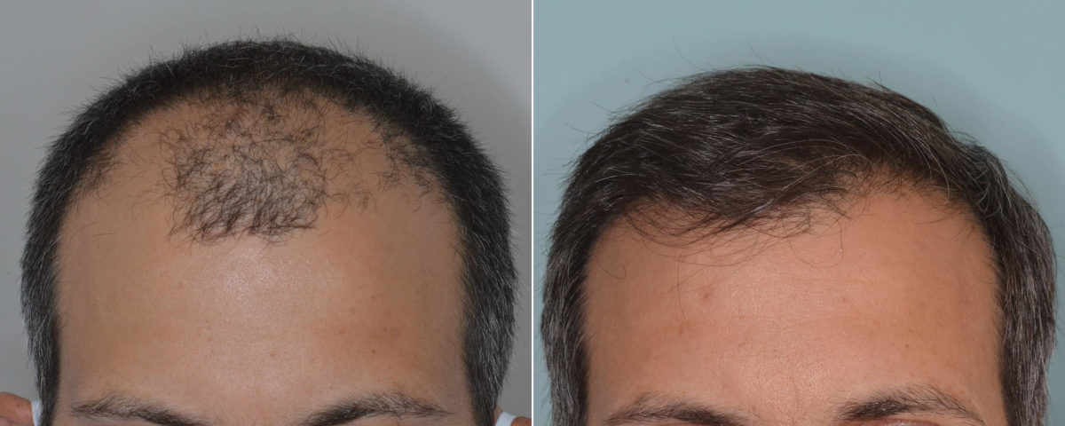 Hair Transplant Before and After Photos in Miami, FL, Patient 4818