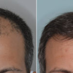 Hair Transplant Before and After Photos in Miami, FL, Patient 4818