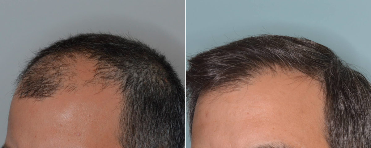 Hair Transplant Before and After Photos in Miami, FL, Patient 4818