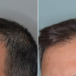 Hair Transplant Before and After Photos in Miami, FL, Patient 4818