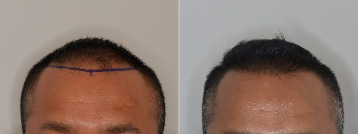 Hair Restoration Before and After Photos in Miami, FL, Patient 4871