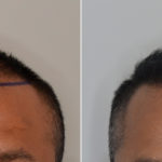 Hair Restoration Before and After Photos in Miami, FL, Patient 4871