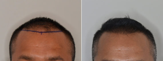 Hair Restoration Before and After Photos in Miami, FL, Patient 4871