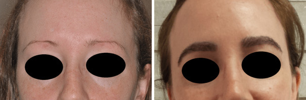 Hair Restoration Before and After Photos in Miami, FL, Patient 1706