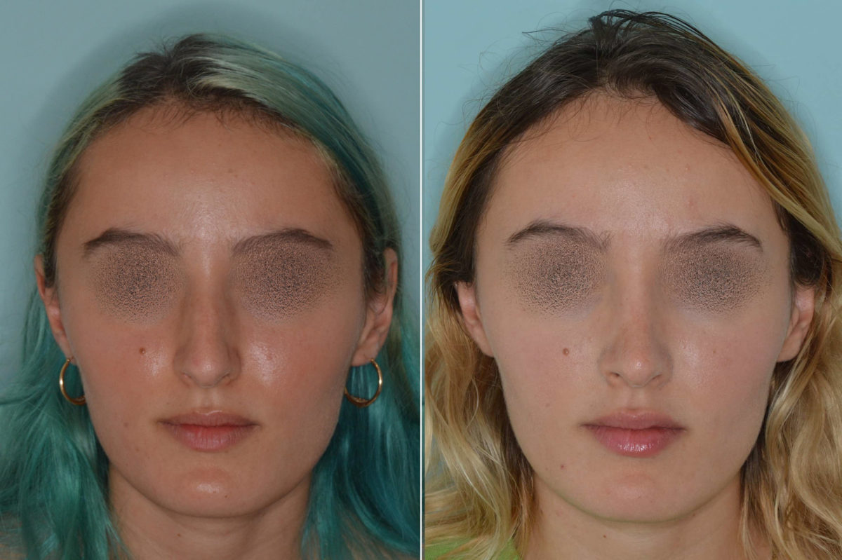 Rhinoplasty Before and After Photos in Miami, FL, Patient 4962