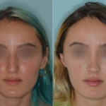 Rhinoplasty Before and After Photos in Miami, FL, Patient 4962