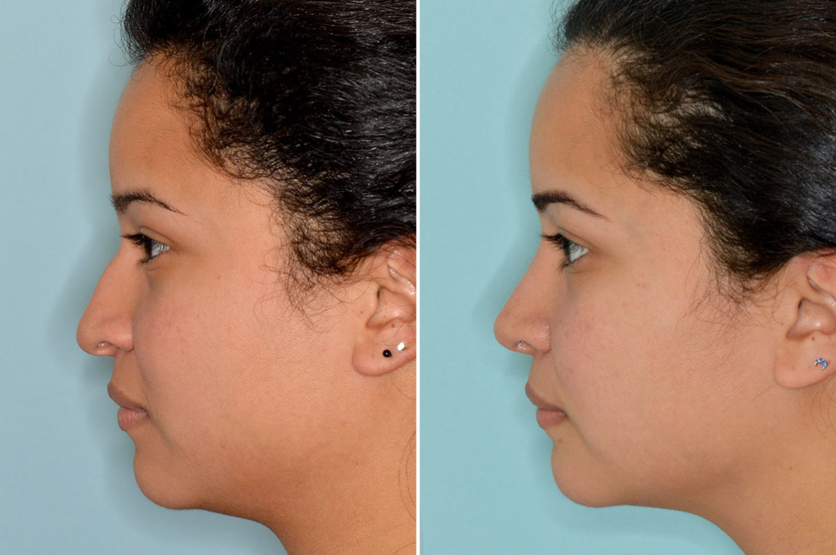 Rhinoplasty Before and After Photos in Miami, FL, Patient 3904