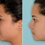 Rhinoplasty Before and After Photos in Miami, FL, Patient 3904