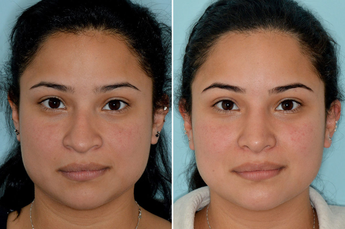 Rhinoplasty Before and After Photos in Miami, FL, Patient 3904