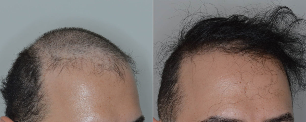 Hair Transplant Before and After Photos in Miami, FL, Patient 5153