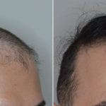 Hair Transplant Before and After Photos in Miami, FL, Patient 5153