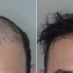 Hair Transplant Before and After Photos in Miami, FL, Patient 5153