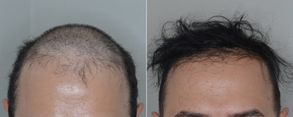 Hair Transplant Before and After Photos in Miami, FL, Patient 5153