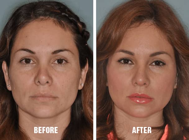 Before and After patients who underwent Revision Rhinoplasty