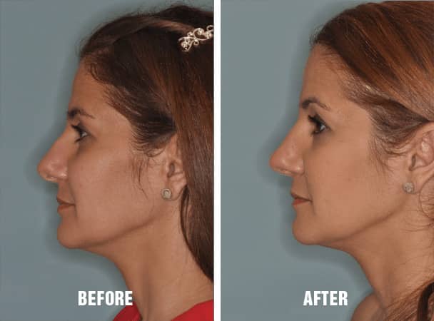 Revision Rhinoplasty Miami