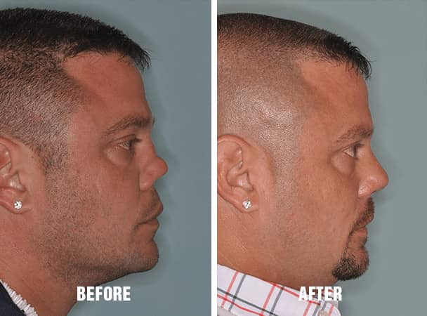 Before and After patients who underwent Revision Rhinoplasty