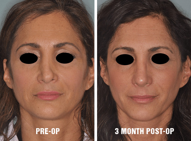 Seen here are pre and post-operative results before and three months after. Note the significant changes in swelling in the elapsed time period.