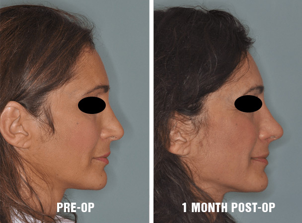 Pre and post-operative results before and three months after (Right)