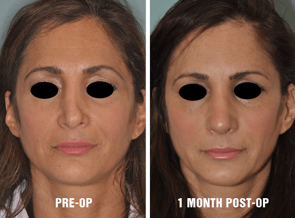 Woman post-operative results before and after 1 month