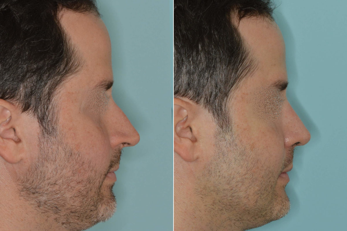 Rhinoplasty Before and After Photos in Miami, FL, Patient 5180