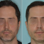 Rhinoplasty Before and After Photos in Miami, FL, Patient 5180