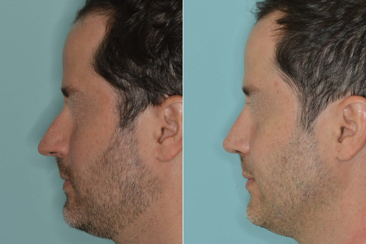 Rhinoplasty Before and After Photos in Miami, FL, Patient 5180