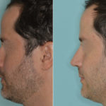 Rhinoplasty Before and After Photos in Miami, FL, Patient 5180